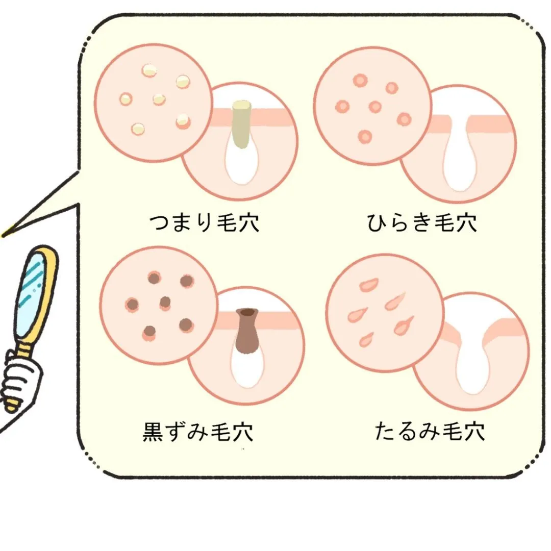 【大阪市中央区】毛穴の種類！４大毛穴？